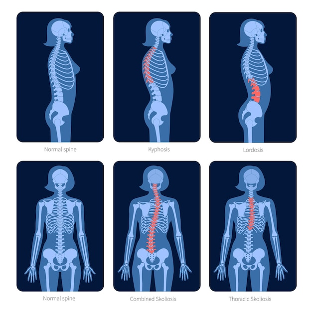 Vector columna vertebral normal y tipos de defectos de la columna. escoliosis en el cuerpo de la mujer. ilustración de vector plano de rayos x. espina dorsal, anatomía del esqueleto en silueta femenina. cartel ortopédico. examen médico en el centro de dolor espinal