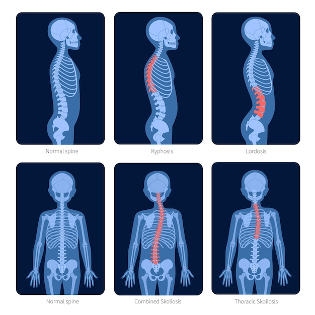 Columna vertebral normal y tipos de defectos de la columna. Escoliosis en el cuerpo del niño. Ilustración de vector plano de rayos X. Espina dorsal, anatomía del esqueleto en silueta de niño. Cartel ortopédico. Examen médico en el centro de dolor espinal