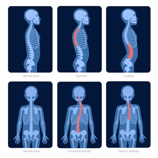 Vector columna vertebral normal y tipos de defectos de la columna. escoliosis en el cuerpo del niño. ilustración de vector plano de rayos x. espina dorsal, anatomía del esqueleto en silueta de niño. cartel ortopédico. examen médico en el centro de dolor espinal