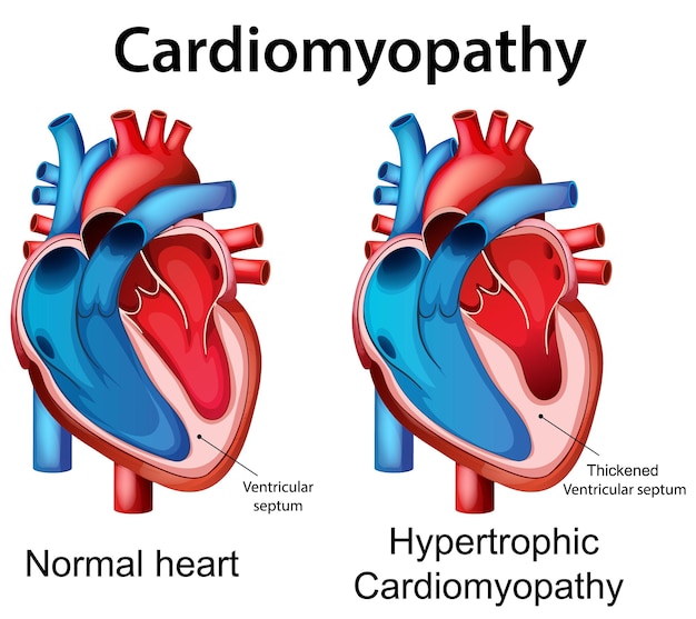 Comparación de los corazones con cardiomiopatía normal y hipertrófica