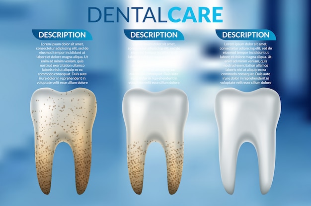 Comparación de dientes limpios y sucios antes y después del tratamiento de blanqueamiento.