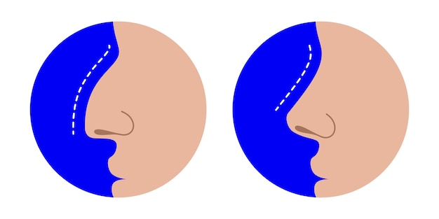 Comparación de nariz torcida y recta antes y después de la ilustración vectorial de corrección de rinoplastia