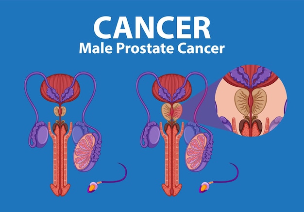 Comparación de la próstata normal y el cáncer en la infografía