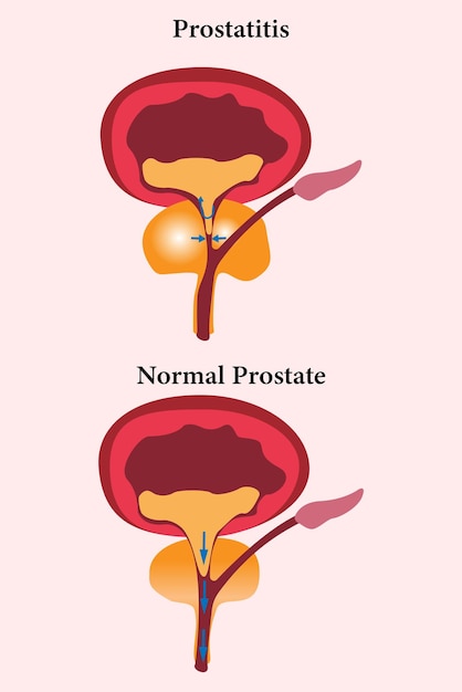 comparación de la próstata saludable y la prostatitis no saludable conjunto de iconos de ilustración