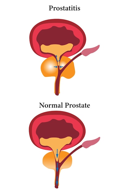 comparación de la próstata saludable y la prostatitis no saludable conjunto de iconos de ilustración