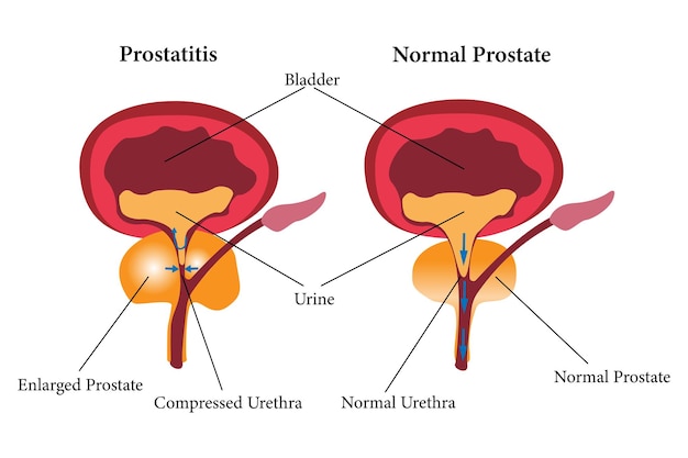 Vector comparación de la salud de la próstata y la mala salud de la prostatitis de la próstata conjunto de iconos de ilustración eps 10