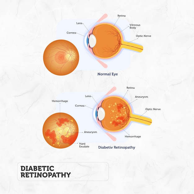 Vector composición médica de anatomía_diabética_retinopatía con subtítulos de texto editables que apuntan a par coloreado