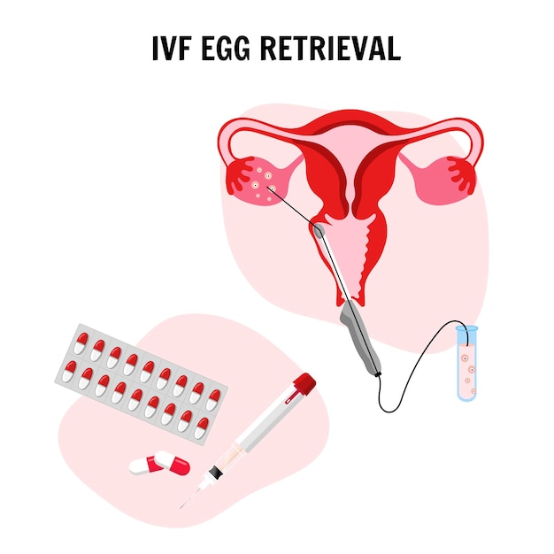 Vector composición médica de fertilización in vitro en vector