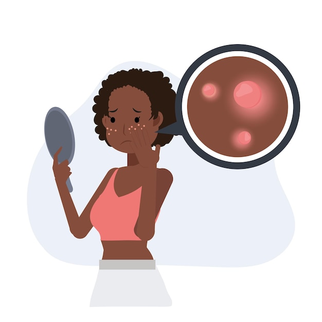 Concepto de acné espinillas. problemas de la piel. La mujer afroamericana está preocupada porque su rostro tiene acné. Ilustración de personaje de dibujos animados de vector plano.