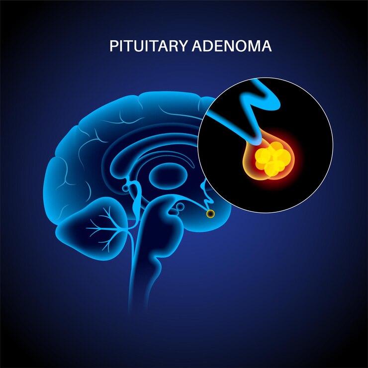 Vector concepto de adenoma hipofisario. tumor en el cerebro humano. enfermedad o cáncer de cabeza. problema de hipotálamo. anatomía de la glándula pituitaria anterior y posterior. ilustración de vector plano médico para clínica