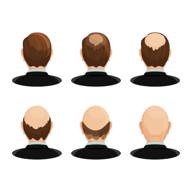 Vector concepto de alopecia. conjunto de cabezas que muestran el progreso de la caída del cabello.