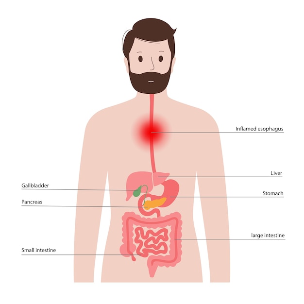 Concepto de cáncer de esófago