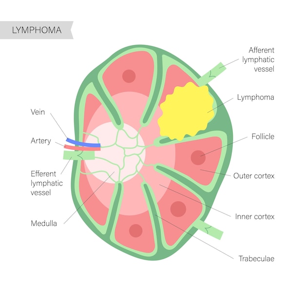 Concepto de cáncer de linfoma