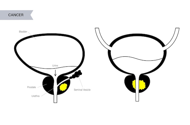 Vector concepto de cáncer de próstata