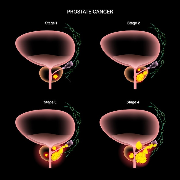 Concepto de cáncer de próstata