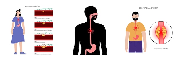 Vector concepto de carcinoma de esófago