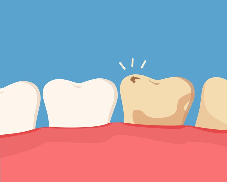 Vector concepto de cavidad dental dientes dañados con caries ilustración de dibujos animados vectoriales