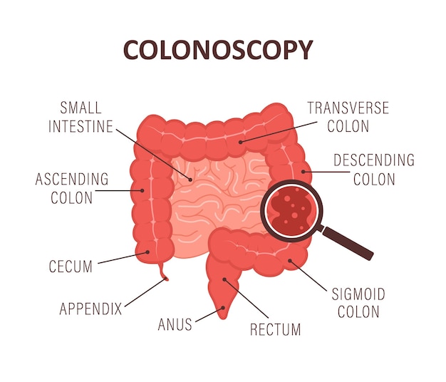 Concepto de colonoscopia Examen y tratamiento del intestino Procedimiento de polipectomía intestinal Anatomía del colon Prevención del cáncer Ilustración vectorial en estilo de dibujos animados planos