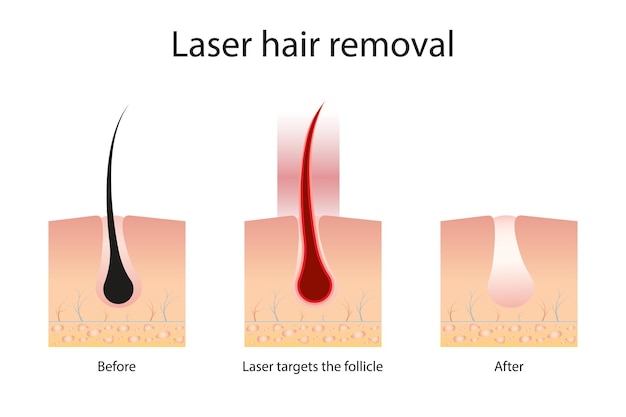 Concepto de depilación láser con áreas de piel y cabello Etapas del procedimiento de depilación Diagra médica