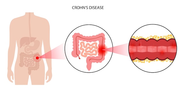 Concepto de enfermedad de chrons