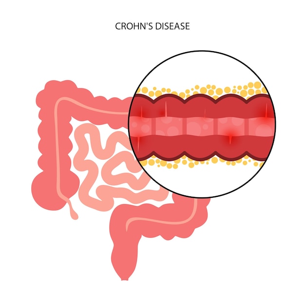 Concepto de enfermedad de chrons