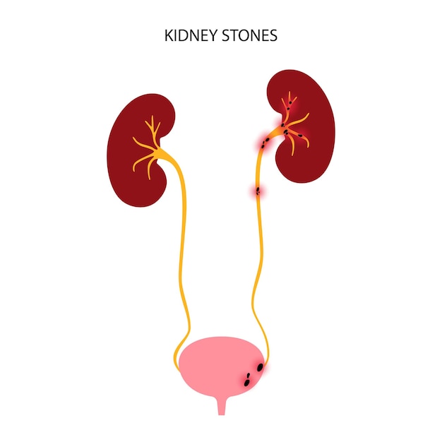 Vector concepto de enfermedad renal