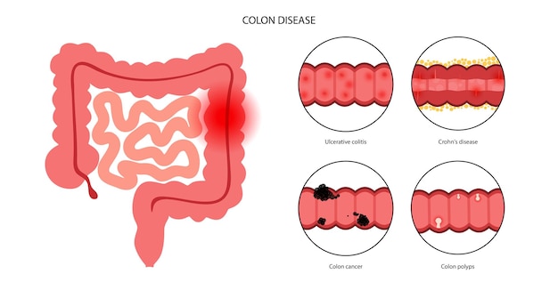 Concepto de enfermedades intestinales