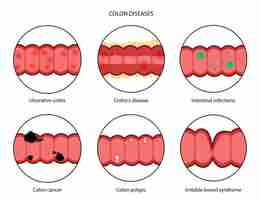 Vector concepto de enfermedades intestinales