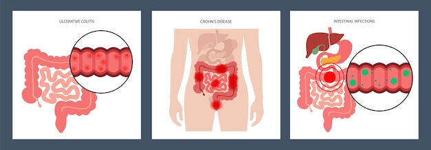 Concepto de enfermedades intestinales