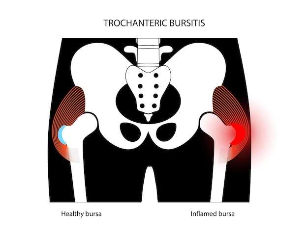 Vector concepto de inflamación de bursitis