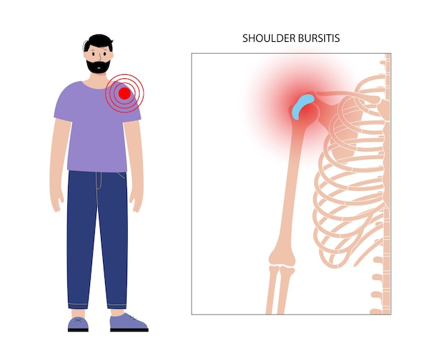Concepto de inflamación de bursitis