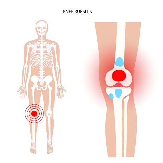 Vector concepto de inflamación de bursitis