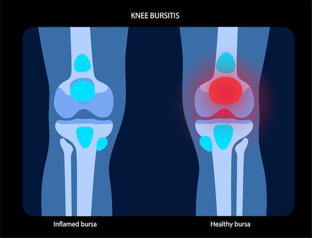 Vector concepto de inflamación de bursitis