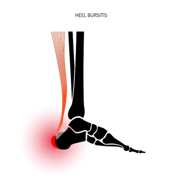 Vector concepto de inflamación de bursitis