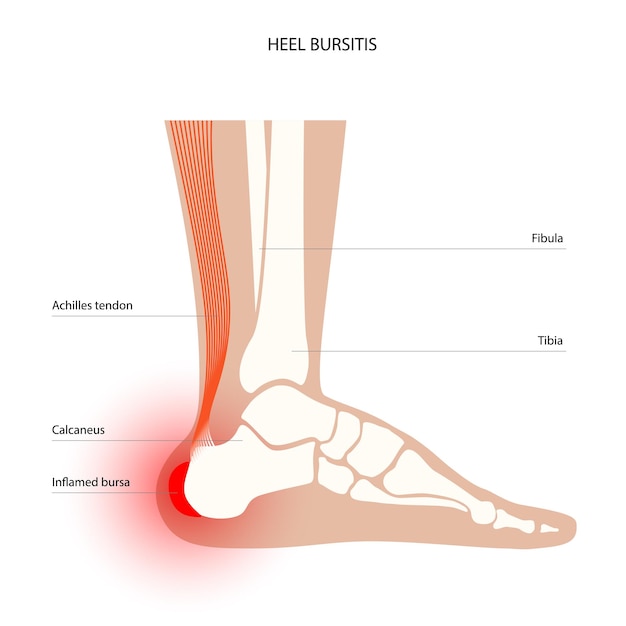 Vector concepto de inflamación de bursitis