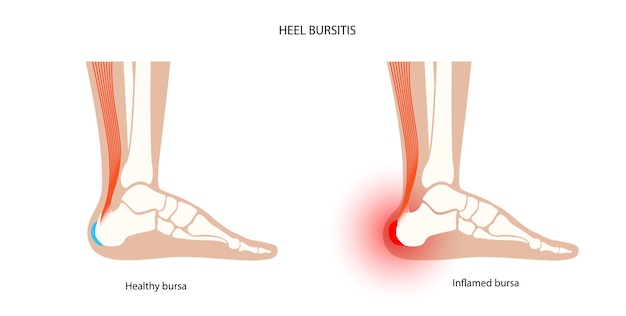 Concepto de inflamación de bursitis