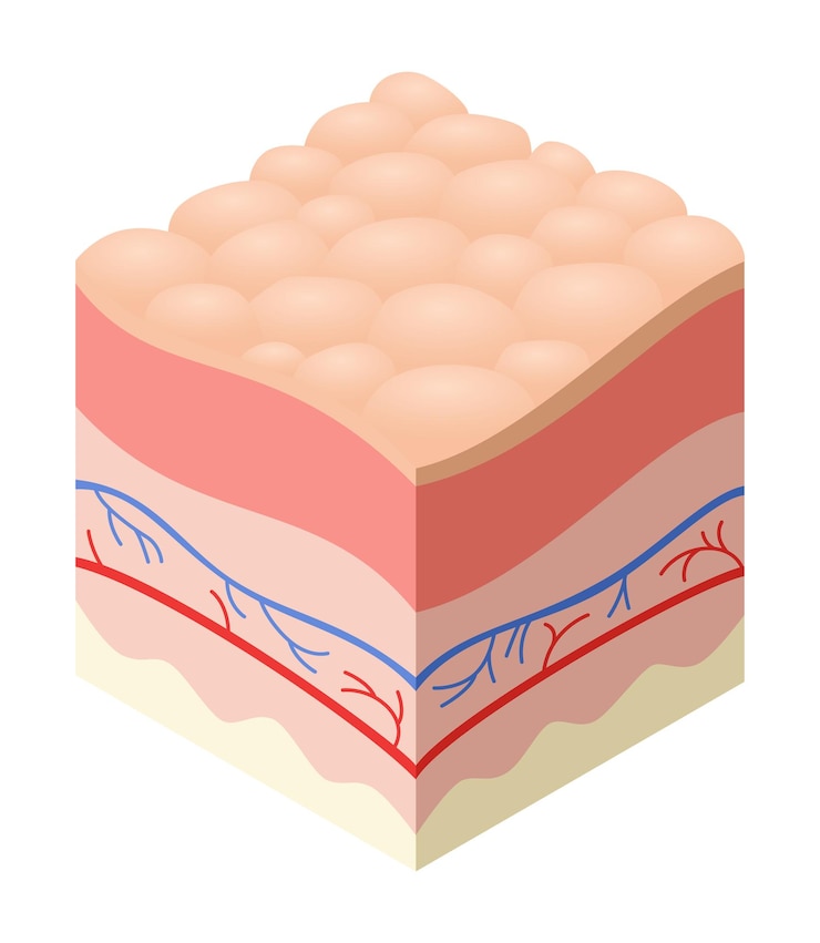 Vector concepto médico para el cuidado de la piel problemas en la sección transversal de la estructura de las capas horizontales de la piel humana modelo ilustrativo de la anatomía capa de piel poco saludable