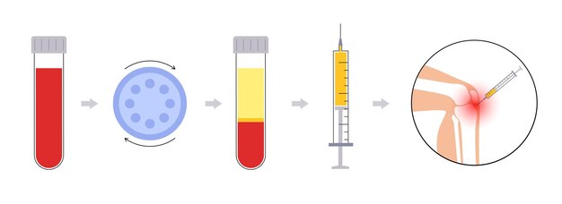 Concepto de plasma rico en plaquetas