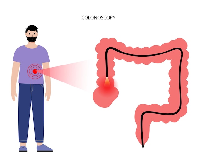 Vector concepto de procedimiento de colonoscopia