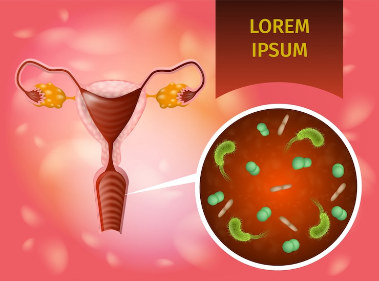 Vector concepto realista del vector de la infección vaginal