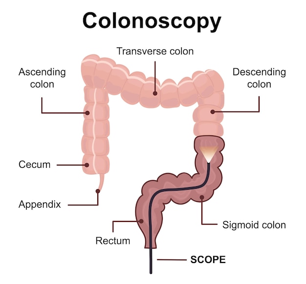 Concepto de tecnología de colonoscopia con endoscopio dentro del intestino