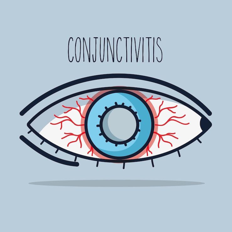 Vector conjuntivitis inflamación alérgica del ojo de visión