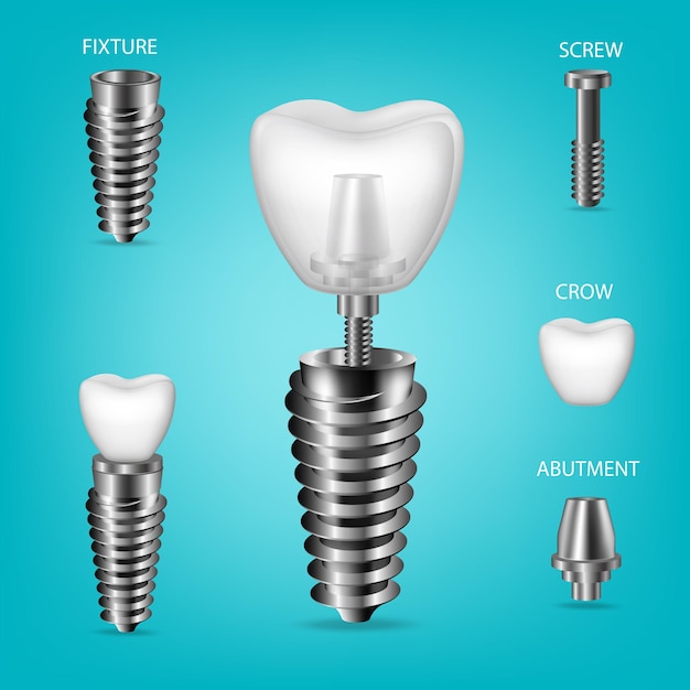 Conjunto 3D realista vectorial de implantes dentales Elementos estructurales de un implante dental aislado