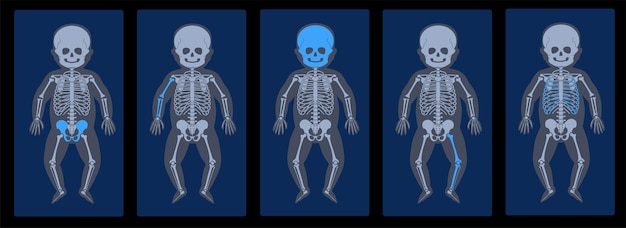 Vector conjunto de anatomía del esqueleto del bebé humano al frente en vista de rayos x. dolor, fractura o inflamación.