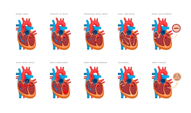 Vector conjunto de defectos cardíacos