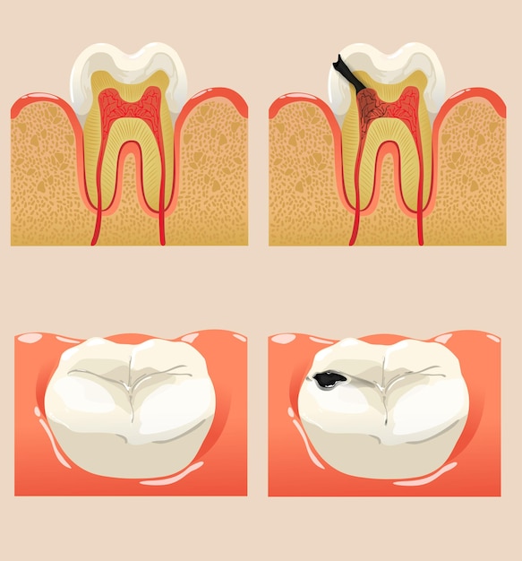 Vector conjunto de dientes con ilustración de vector de caries