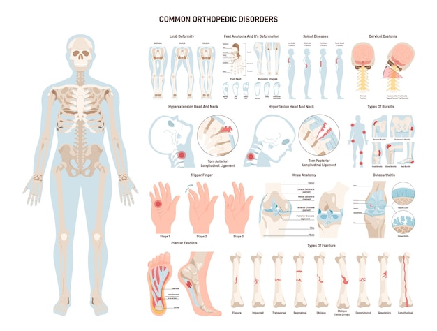 Conjunto de enfermedades ortopédicas Lesiones de ligamentos y articulaciones del esqueleto humano