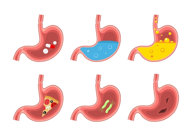 Conjunto de estómago sano y enfermo. Dolor de estómago, gastritis, indigestión, vómitos, acidez de estómago. Digestivo, system., Medicina, anatomía, humano, estómago., Vector, plano, ilustración, aislado, blanco, backgroun