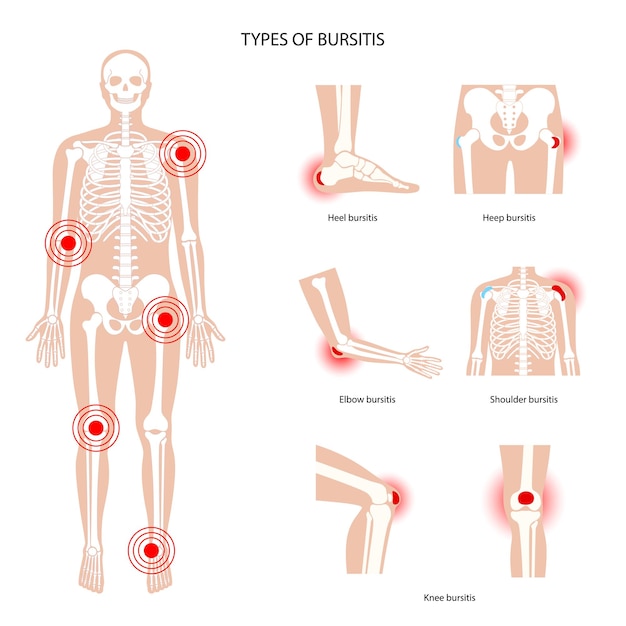 Conjunto de iconos de bursitis