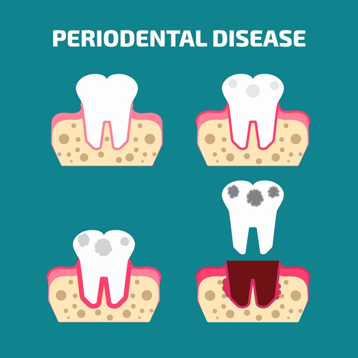 Vector conjunto de iconos de enfermedad periodontal